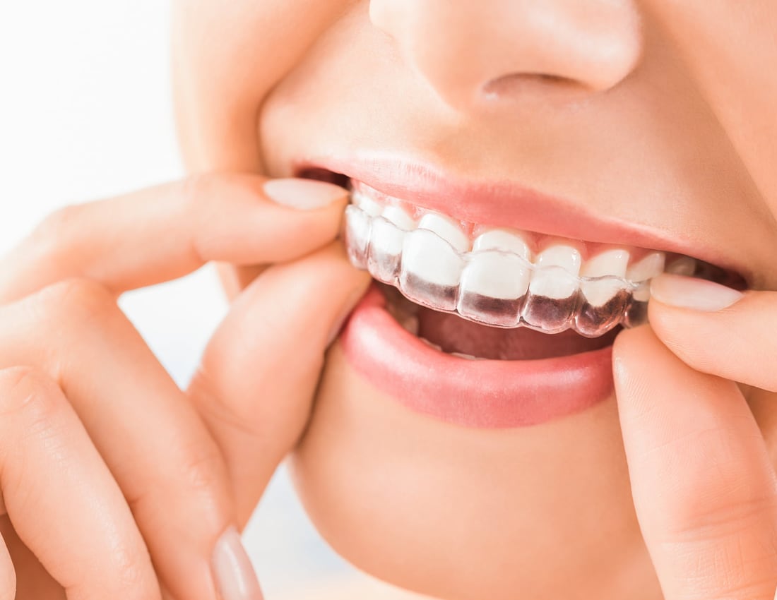 Invisible orthodontics